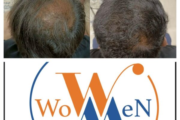 “WowMen Clinic: 10+ Years & 4500+ Satisfied Clients, A Leader in Sustainable Cosmetic Treatments!”