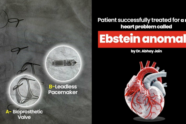Patient successfully treated for a rare heart problem called Ebstein anomaly by Dr. Abhay Jain