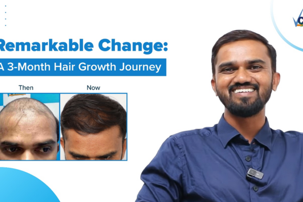 Unlock Your Confidence with VCare’s Revolutionary Hair Regrowth Solution!