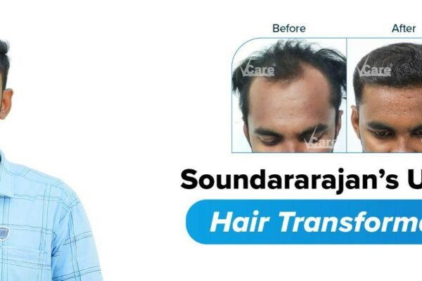REVERSING BALDNESS WITH VCARE