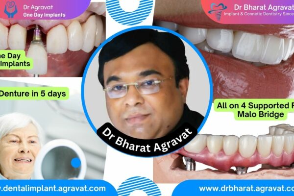 Best Dentist for Full Mouth Dental Implants Clinic in Ahmedabad: Dr. Bharat Agravat, the top Implantologist.