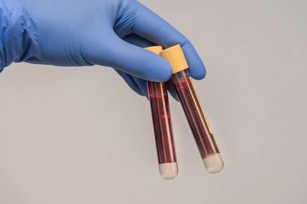 How Routine Blood Tests Can Help You Stay Ahead of Health Issues?
