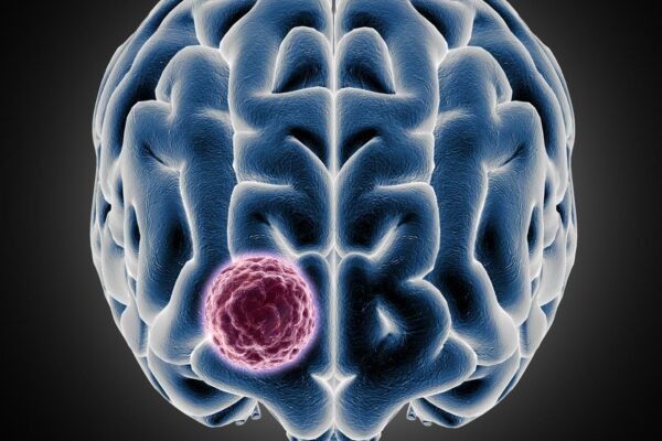 Sakra successfully conducts a landmark surgery for 10*9 cm giant meningiomaon a 34-year-old  international patient from Ghana
