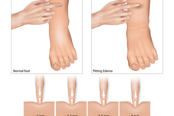 What is the most common cause of fluid retention and how it affects your blood pressure?