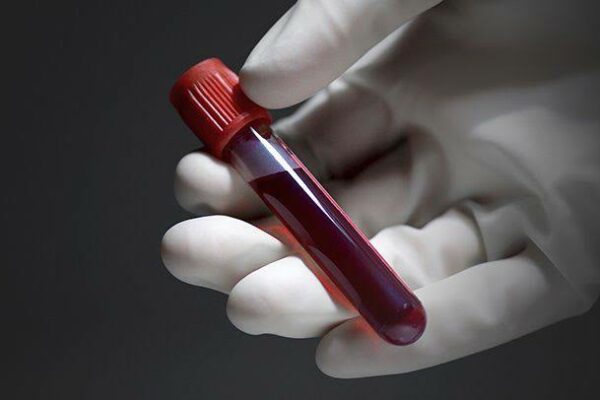 Widal Test: A Test To Confirm Typhoid Fever