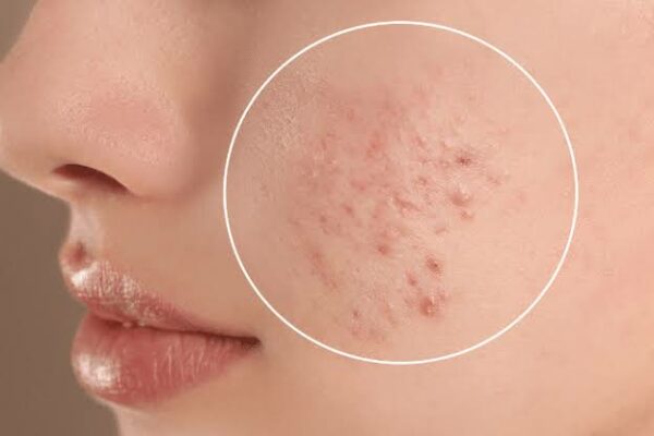 How to Treat Acne and Pigmentation?