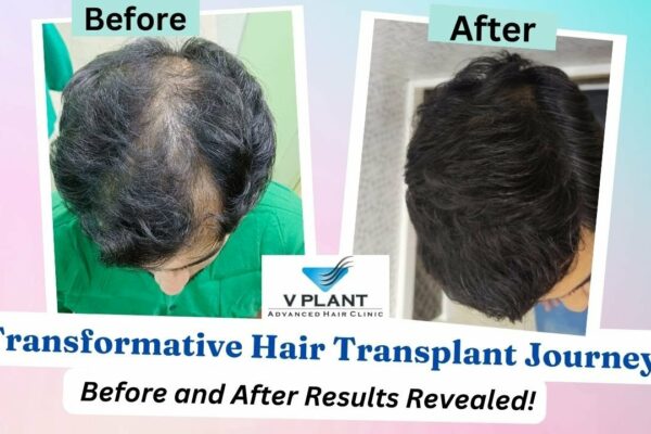 Vplant Hair Clinic Mumbai Introduces Advanced MHI Hair Transplant Technique for Painless, Scar-Free Results