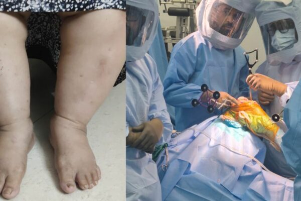 From 140 KGs and Years of Knee Pain to Walking Freely: Dr. Saikat Jena Restores a Woman’s Life with Surgery