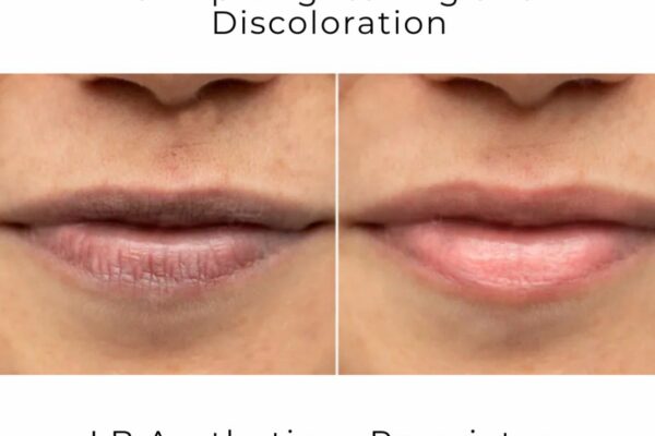 LB Aesthetics Leads the Way in Pigmentation Treatments in Delhi